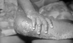 Premier cas de variole du singe en Ile-de-France